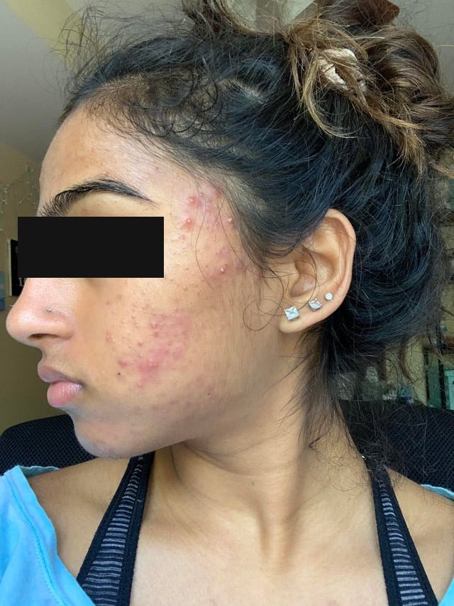 Julieth Alejandra con acné inflamado en la mejilla y la sien antes del programa