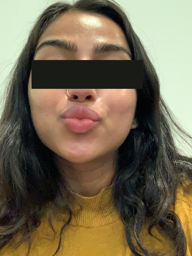 Julieth Alejandra con la piel limpia, otra foto después del programa