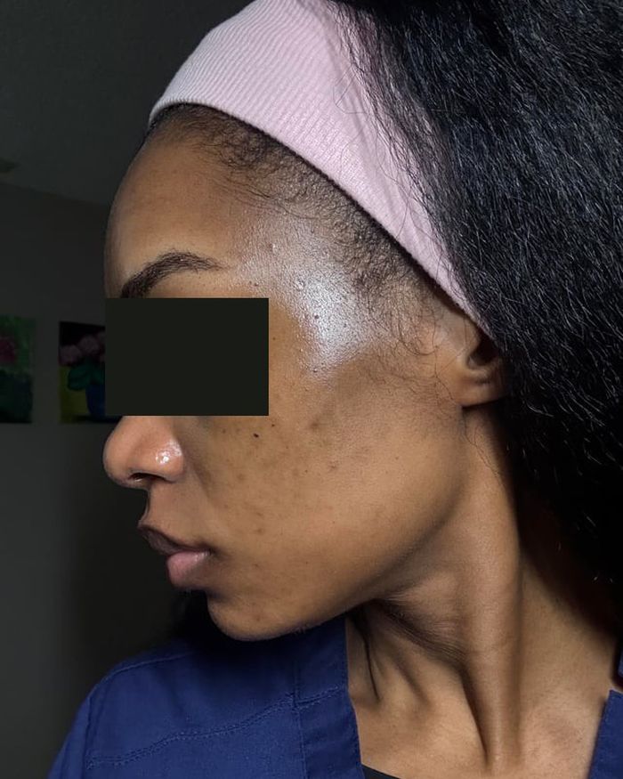 Perfil de Elena con la piel limpia al terminar